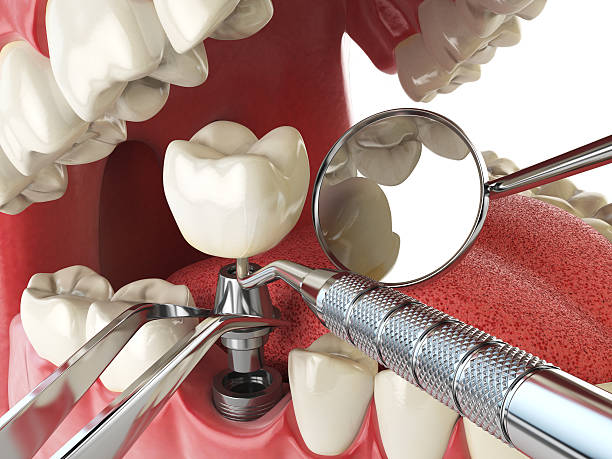 Best Emergency Dental Care for Broken or Chipped Teeth in Crystal Lake, FL